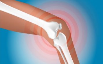 Trois compléments pour les articulations anti-inflammatoires naturels : les compléments nutritionnels pour soigner les rhumatismes